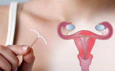 Спираль Мирена. Лучший выбор женской контрацепции 