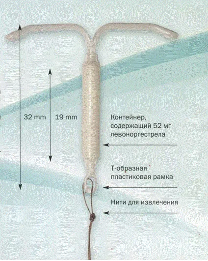 Спираль Мирена