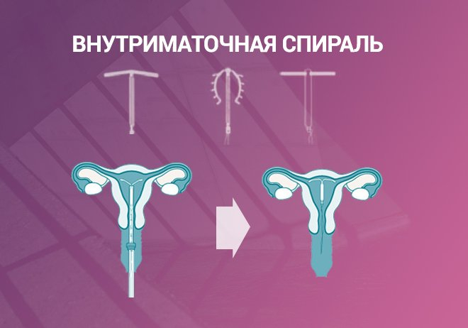 Как выбрать внутриматочную спираль